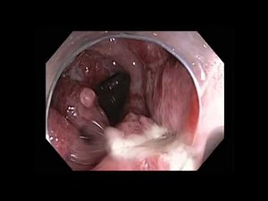 Inflammatory Polyposis in Colonoscopy • Video • MEDtube.net
