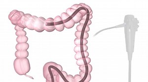 3D Medical Animation Colonoscopy Procedure | Medical Video