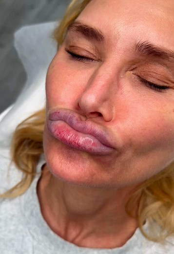 Fixing Botched Lip Filler: Aesthetic Doctor's Guide