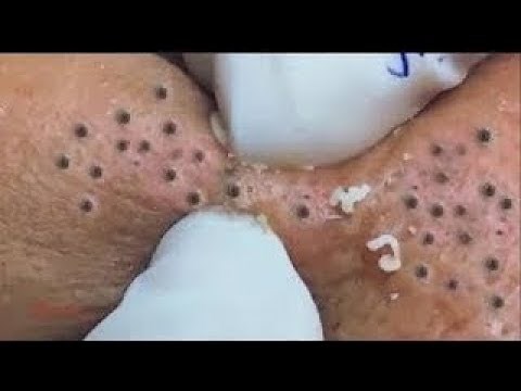 blackheads removing - how to remove blackhead on cheek - blackhead 2019
