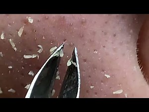 Blackhead Blitz: Deep Dive Extraction