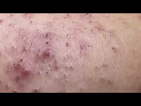 Huge blackhead removal from nose /old aged blackheads removal / blackheads new this week 2023 /6