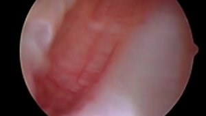 Primary ACL Reconstruction with B-PT-B Autograft