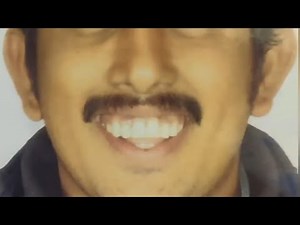 Surgically assisted Rapid maxillary expansion in an adult to correct severe malocclusion