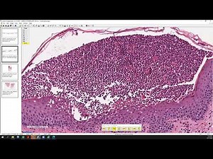 Acute generalized exanthematous pustulosis (AGEP), pustular psoriasis, and Sneddon-Wilkinson.