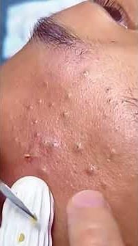 Huge Blackhead Extraction: Extremely Satisfying!