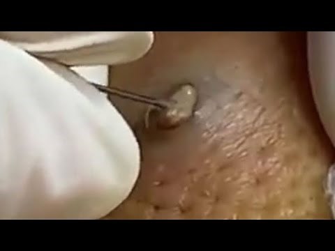 2020 Comedones Popping! Dermatology, Blackheads, Zits and Whiteheads! Cysts