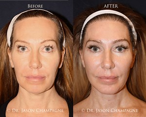 Hairline Lowering & Forehead Reduction Surgery in the USA