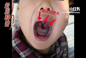 什么是扁桃体肥大