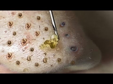 Loan Nguyen Acne Treatment (#161)