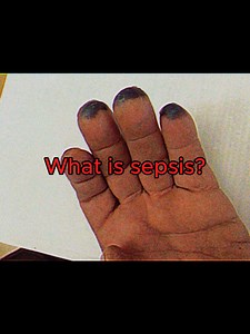 What is sepsis? #sepsis #septicshock #keejefferson #fyp #infotok #xyzbca #foryou