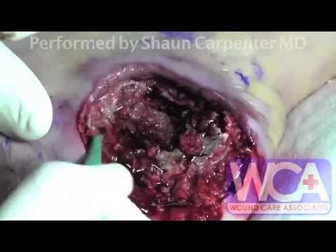Maggot Therapy for wounds diabetic foot follow up - debridement + platelet rich plasma
