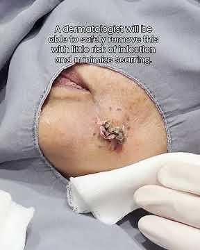 Cute Cyst Jaw Extraction