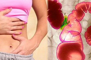 Irritable bowel (colitis): diagnosis, symptoms and treatment