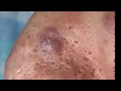 Pimples Popping On Nose Part 1