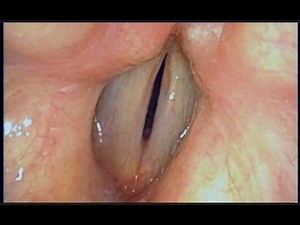 Fiberoptic Laryngoscopy with Strobe