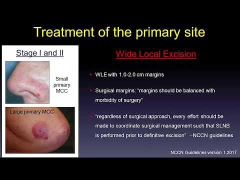 Update in Medical Treatment of Merkel Cell Carcinoma