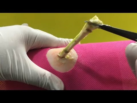 BEST Pimple Popping // Big Cystic Acne Blackheads / Whiteheads Removal / Blackhead Removal / VL#043