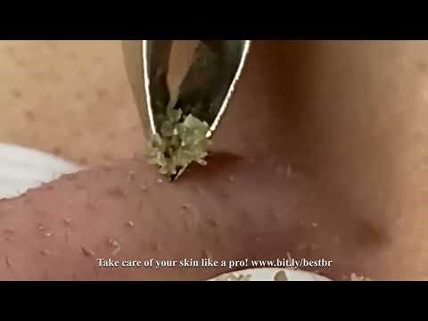 Precision Blackhead Extraction: Tweezer Technique on the Nose - bit.ly/bestbr