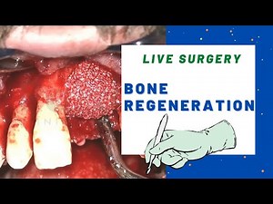 BONE REGENERATION surgery - Bone grafting technique live.