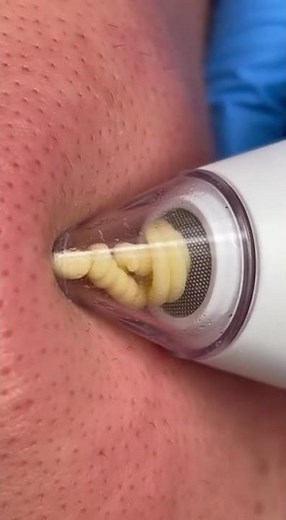 🤯 UNBELIEVABLE! Watch This Pore Vacuum Extract EVERYTHING From Clogged Pores!