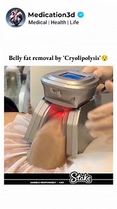 medication3d 👉Cryolipolysis, also known as CoolSculpting, is a non-invasive belly fat removal treatment. It uses cold temperatures to freeze and kill fat cells, which are then naturally eliminated by the body. A device is applied to the target area, cooling the fat cells to a temperature that causes cell death. The procedure is painless, requires no downtime, and results in a noticeable reduction of belly fat. Pls consult a certified doctor for the treatment.👩🏻‍⚕️ You will never see this page
