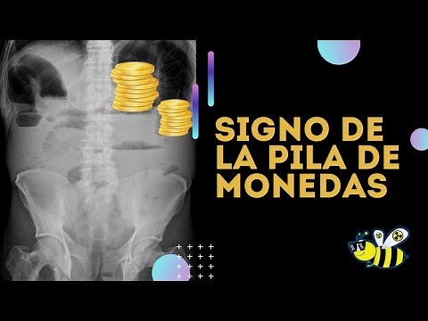Signo de la pila de monedas en radiografía. Que puede significar?