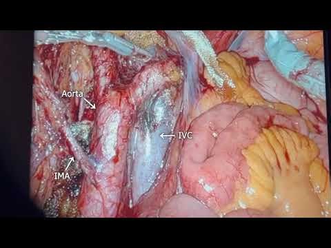 Morning Robotic Surgery views that We like | Precision in Motion: Robotic Oncogyne Anatomy Revealed!