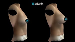 Crisalix 3D Breast Augmentation Simulation