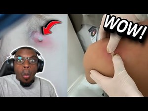 Unbelievable UNDER ARM BOIL EXPLODES!!