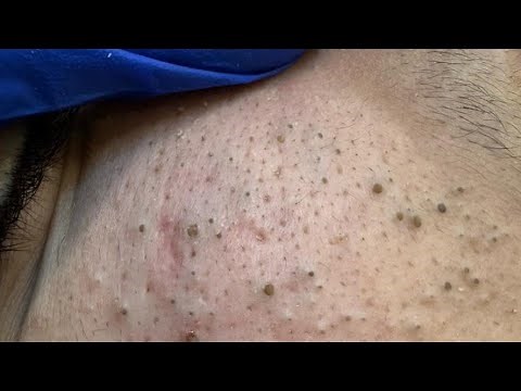 Deep Cleansing Techniques For Clear Pores — Extreme Blackhead Extraction