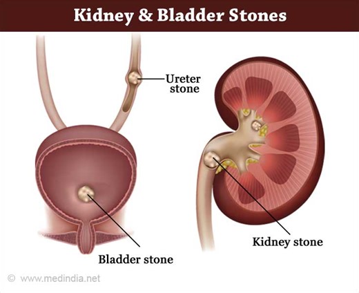 Kidney Stones / Renal Stones - Causes - Symptoms - Diagnosis - Treatment - FAQs