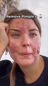 750K views · 6.7K reactions | How to get rid of pimples ✅ Remove...