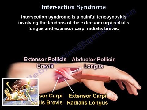Intersection Syndrome - Everything You Need To Know - Dr. Nabil Ebraheim