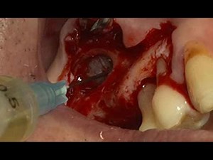 Implantation on maxillary sinus with chronic sinusitis (Short)