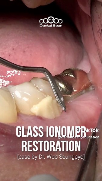 Glass Ionomer Restoration Techniques for Dentists