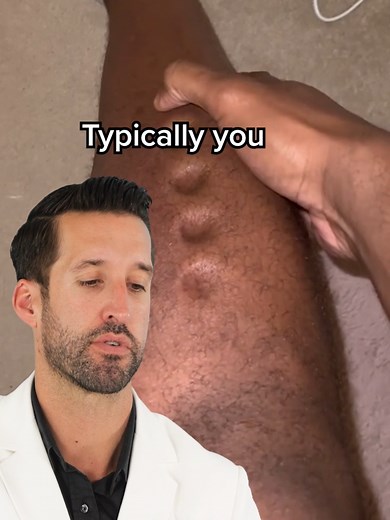 Doctor Reacts to Leg Holes & Pitting Edema