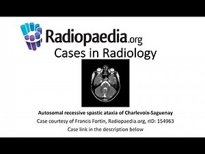 Autosomal recessive spastic ataxia of Charlevoix-Saguenay (Radiopaedia.org) Cases in Radiology