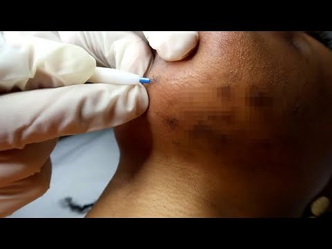 Poils du visage, tâches: épilation définitive à l'électrolyse! (peau noire) / institut Pyrène