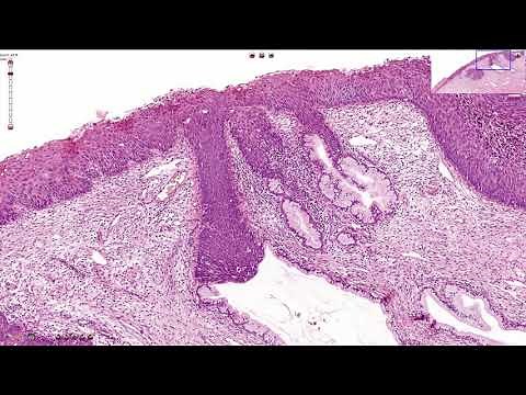 HSIL - High Grade Squamous Intraepithelial Lesion - Histopathology