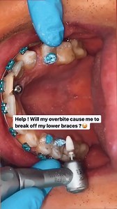 By • @drsuliman_orthodontist What is a Turbo for teeth? Bite turbos are also known as bite ramps or bite blocks. Bite blocks are made out of blue or tooth colored material. They are tooth-supporting platforms, which impact the upper front teeth. By wearing bite turbos; braces patients treat a variety of issues, such as overbite, deep bite, and improper teeth movement. #orthodontics #bracesproblems #ceramicbraces #metalbraces | Dentistry blog | Facebook