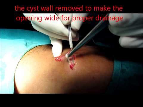 Sebaceous Cyst Back Drained Properly