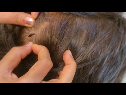 ASMR ✨ Scalp Check and Treatment ( Real Person) #asmr #satisfying #tingles