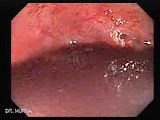 Massive Rectal Bleeding (2 of 11) • Video • MEDtube.net