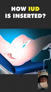 1.8M views · 10K reactions | How Intrauterine Device ( IUD ) Is Inserted? | Jengle Maravilla Sabado | Facebook