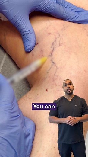 No visible veins? That doesn’t mean no vein problem. Dr. Deygoo explains how chronic venous insufficiency can exist deep beneath the skin, even without bulging or spider veins. If you’re experiencing heaviness, aching, cramping, swelling, fatigue, or restless legs, it may be worth getting evaluated. 💙 👉🏼 Click the link in our bio ☎️ Or call 844-382-8422 now! #VaricoseVeins #HealthyLegs #SpiderVeins #Wellness #Health