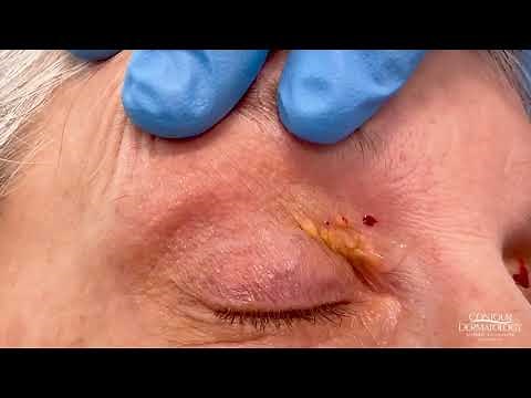 Yellowish Plaque On The Eyelid (Xanthelasma Treatment) | CONTOUR DERMATOLOGY