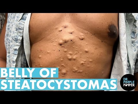 A Belly Full of Steatocystomas Full Video!