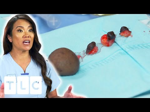 Dr Sandra Lee Removes Unusual Bumps From Patient | Dr Pimple Popper | UNCENSORED | 18+