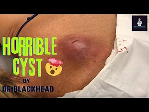 GIANT CYST ON BACK | The BIGGEST Cyst I Has Ever Seen!